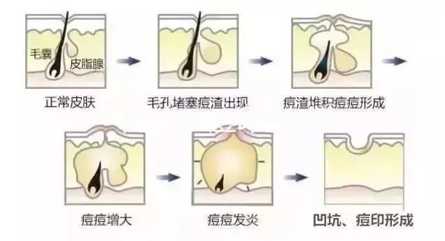如何祛除痘坑？祛除痘坑最好的方法