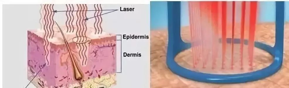 如何祛除痘坑？祛除痘坑最好的方法