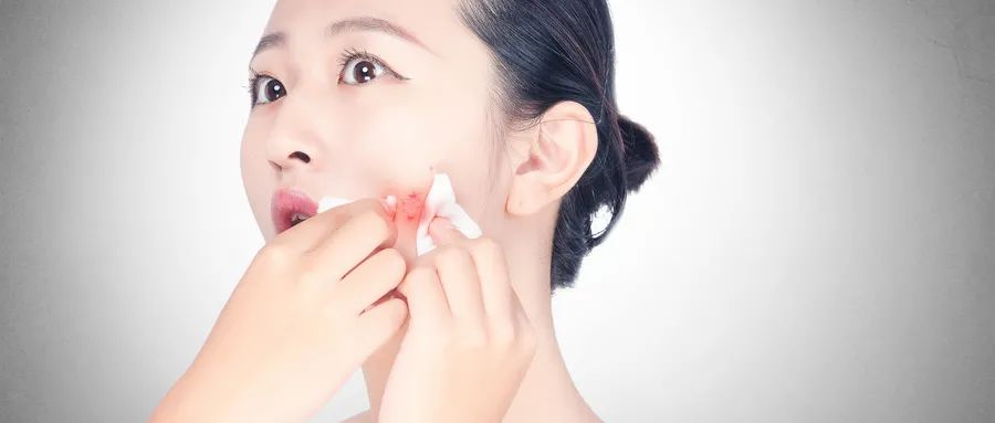 如何預(yù)防粉刺的發(fā)生和痤瘡的形成？