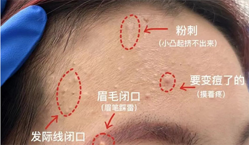 臉上經(jīng)常長閉口粉刺的原因有哪些？