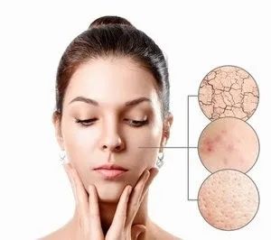 什么是春敏？如何預(yù)防春敏？