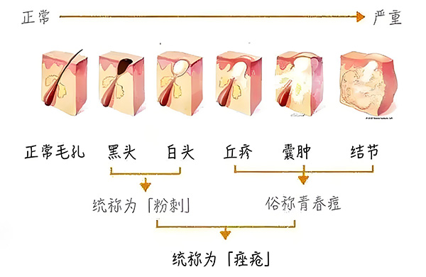 黑頭怎么去除最有效？去除黑頭最有效的方法