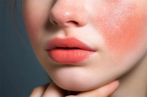 秋季皮膚為什么容易過敏？