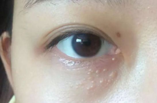 為什么眼部容易長脂肪粒？