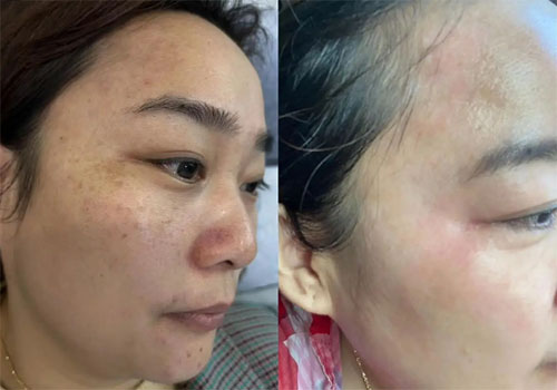 祛斑最好的土方法有哪些？