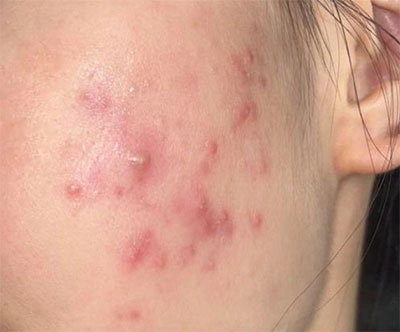 油痘肌和油敏肌怎么區(qū)分？油痘肌和油敏肌的區(qū)別！