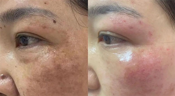 祛斑后為什么會(huì)反黑？祛斑后會(huì)反黑是什么原因？