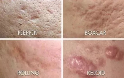 如何祛除痘坑？祛除痘坑最好的方法