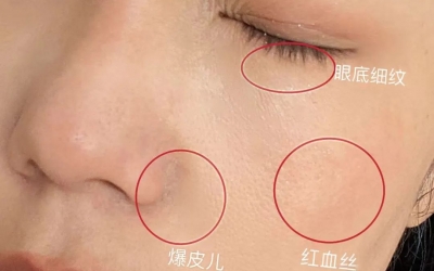 如何判斷自己是不是干敏肌膚？干敏肌有哪些特征？