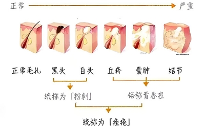 黑頭怎么去除最有效？去除黑頭最有效的方法