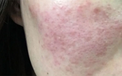 皮膚泛紅癢是什么原因？皮膚紅癢怎么回事？