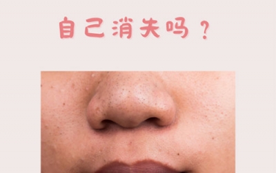 什么是黑頭？怎樣預(yù)防黑頭的形成？