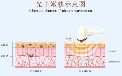 光子嫩膚術前注意事項有哪些？